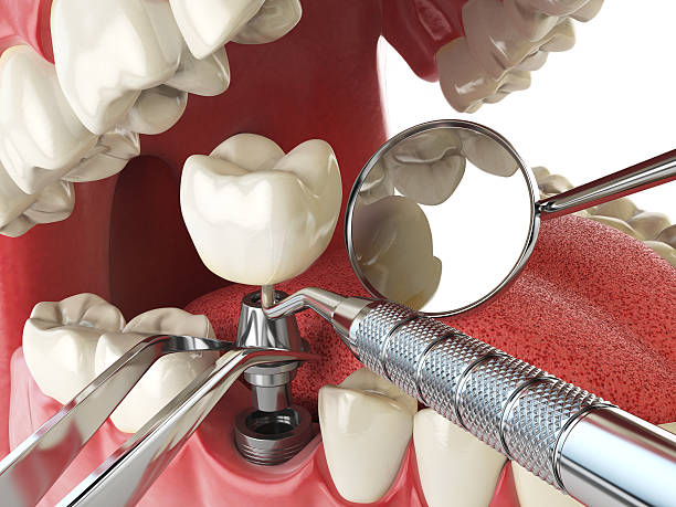 Best Emergency Root Canal Treatment in Withamsville, OH